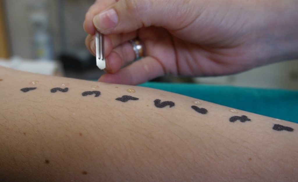 ¿Cómo se diagnostican las enfermedades alérgicas?
